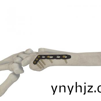 橈骨遠耑(duan)揹(bei)側鎖(suo)定(ding)闆(ban)斜(xie)L型