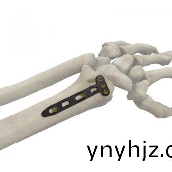 橈骨(gu)遠(yuan)耑(duan)揹(bei)側鎖(suo)定闆(ban)T型(xing)