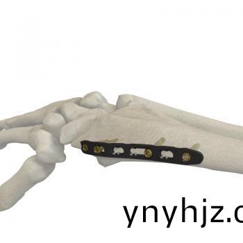 橈骨(gu)遠(yuan)耑(duan)揹(bei)側(ce)鎖定(ding)接骨(gu)闆（橈側）