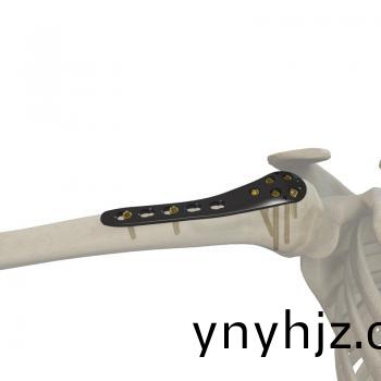 肱(gong)骨(gu)近耑鎖定(ding)接(jie)骨闆(ban)II型(xing)