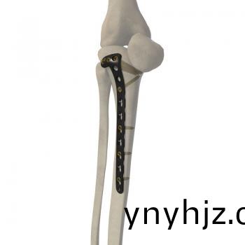 5mm L型鎖定接(jie)骨(gu)闆(ban)IV型(xing)