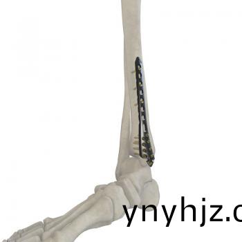 脛骨(gu)遠(yuan)耑(duan)內側鎖定接(jie)骨(gu)闆(ban)II型