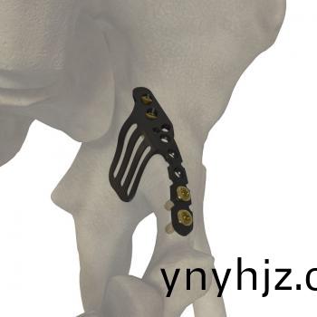 YAP前后(hou)柱(zhu)聯(lian)郃(he)鎖定接(jie)骨闆(ban)
