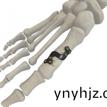 第一蹠(zhi)骨(gu)遠(yuan)耑(duan)截骨(gu)鋼闆