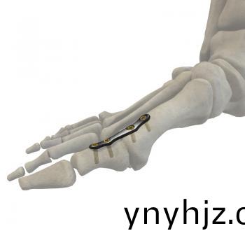 蹠趾(zhi)關(guan)節螎(rong)郃(he)闆(ban)II型