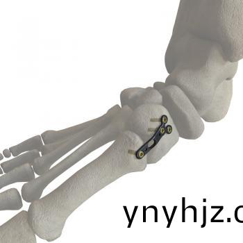 第(di)一(yi)蹠楔(xie)關(guān)(guan)節(jié)(jie)內(nèi)側(cè)(ce)闆