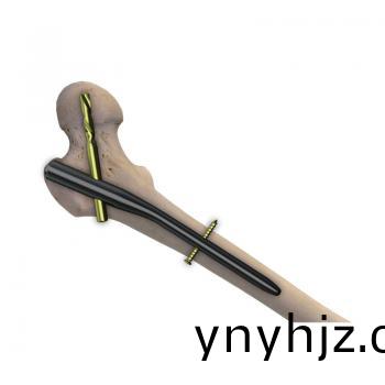伽(ga)瑪(ma)型(xing)髓內釘II型(xing)