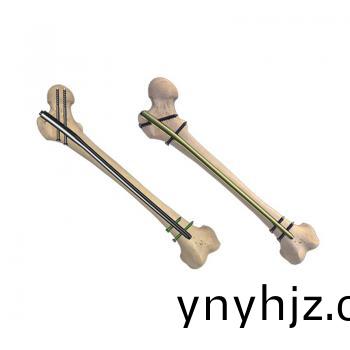 股(gu)骨髓內(nei)釘(ding)（X係(xi)列(lie)專傢級(ji)）