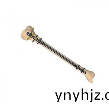 脛骨(gu)髓內(nei)釘（X係列專(zhuan)傢級(ji)）